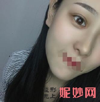 四川華西醫院整形科李正勇雙眼皮案例？讓我擁有了一雙迷人的眼睛~